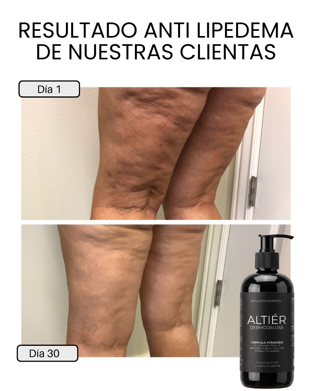 DERMODELUXE - Dermocosmético para lipedema y celulitis avanzada