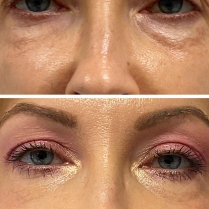 ProLift 2.0 Micro-Conos para Ojos Maduros