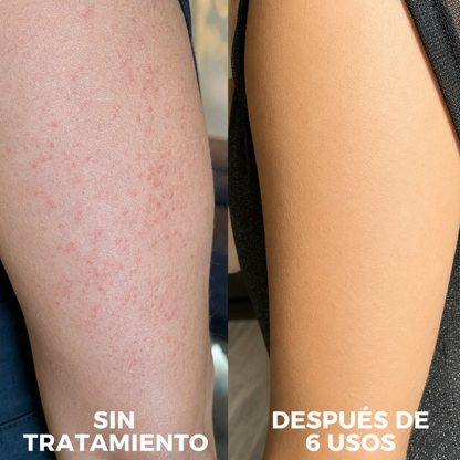 DERMAPURA - Recuperá una piel lisa y libre de granitos