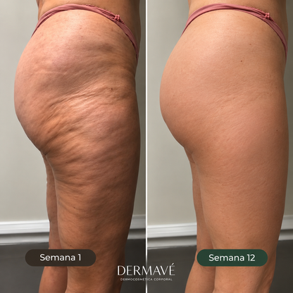 Dermavè™ | Aceite Corporal Reafirmante - Anticelulitis , flacidez y arrugas